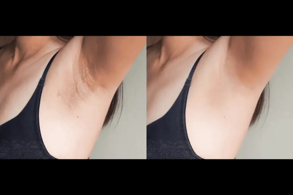 Intimate Lightning Body Peel in Marietta GA | APMU Med Spa