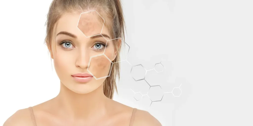 Medium depth chemical peels in Marietta GA by APMU Med Spa