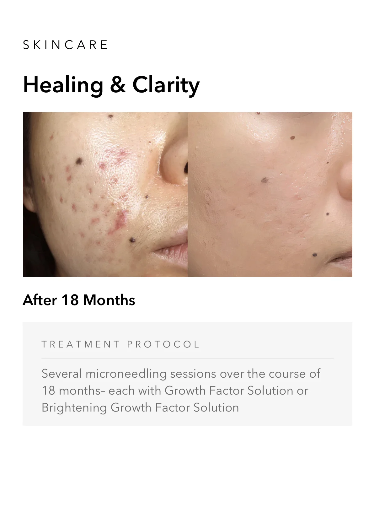 ejuvapen-microneedling-nxt-gallery-a