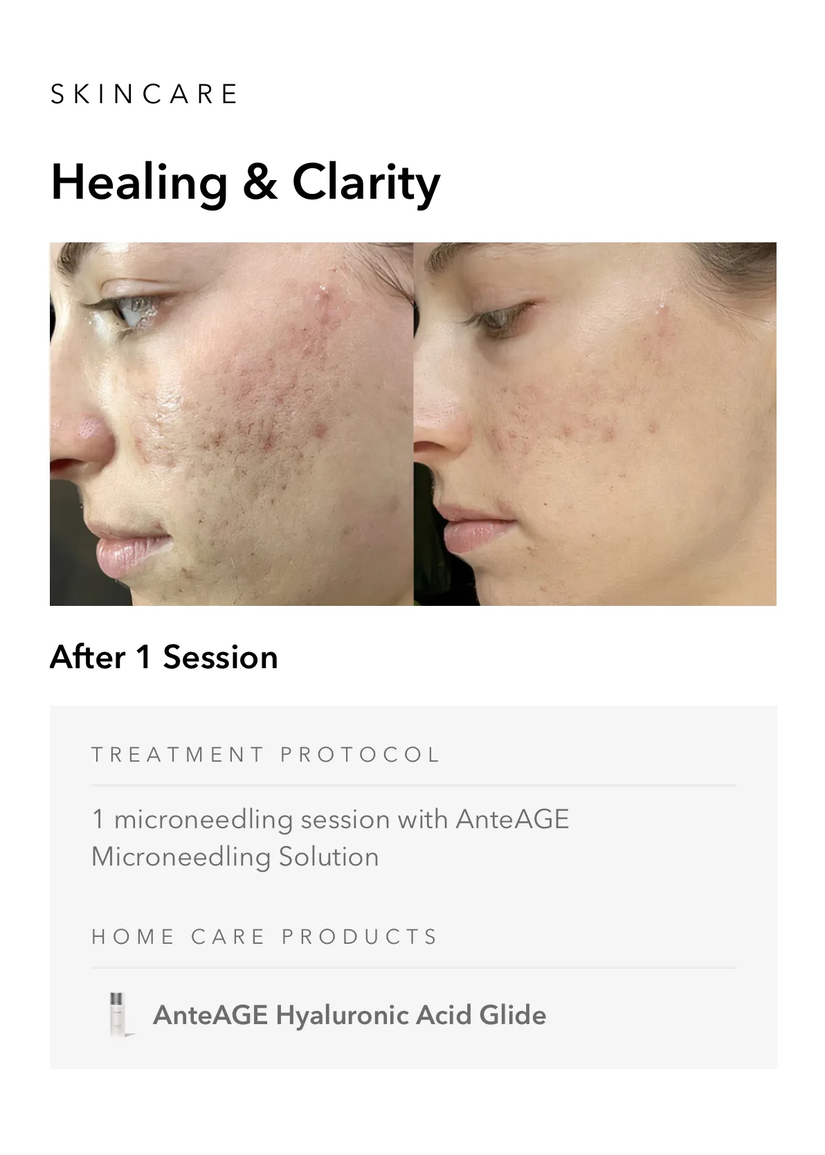 ejuvapen-microneedling-nxt-gallery-b