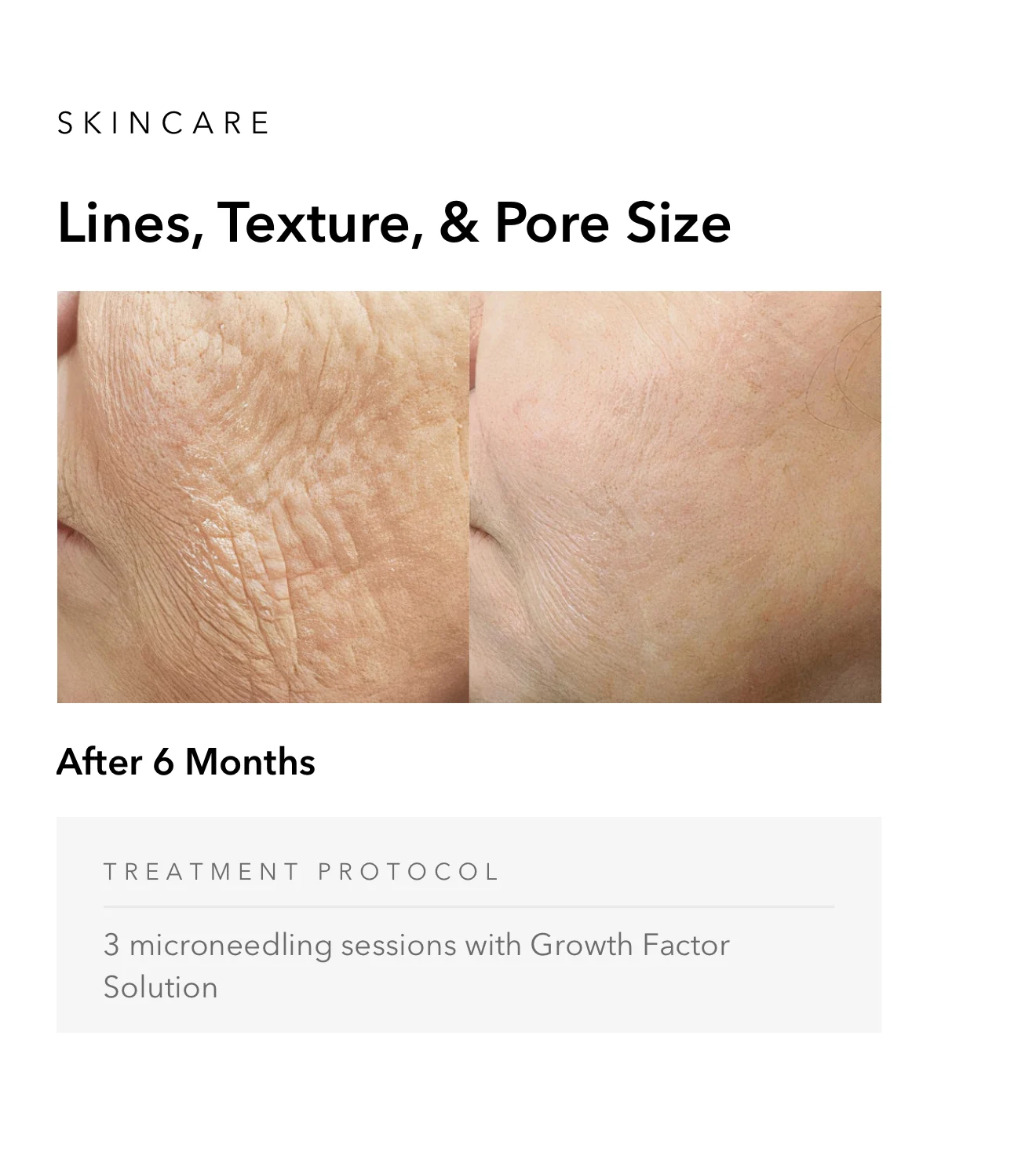 ejuvapen-microneedling-nxt-gallery-c