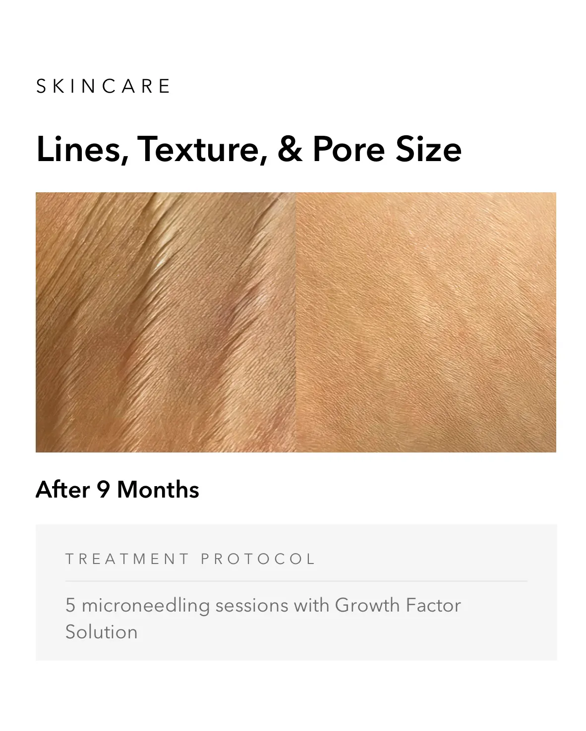 ejuvapen-microneedling-nxt-gallery-d