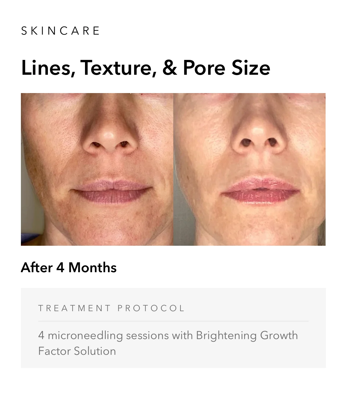 ejuvapen-microneedling-nxt-gallery-e