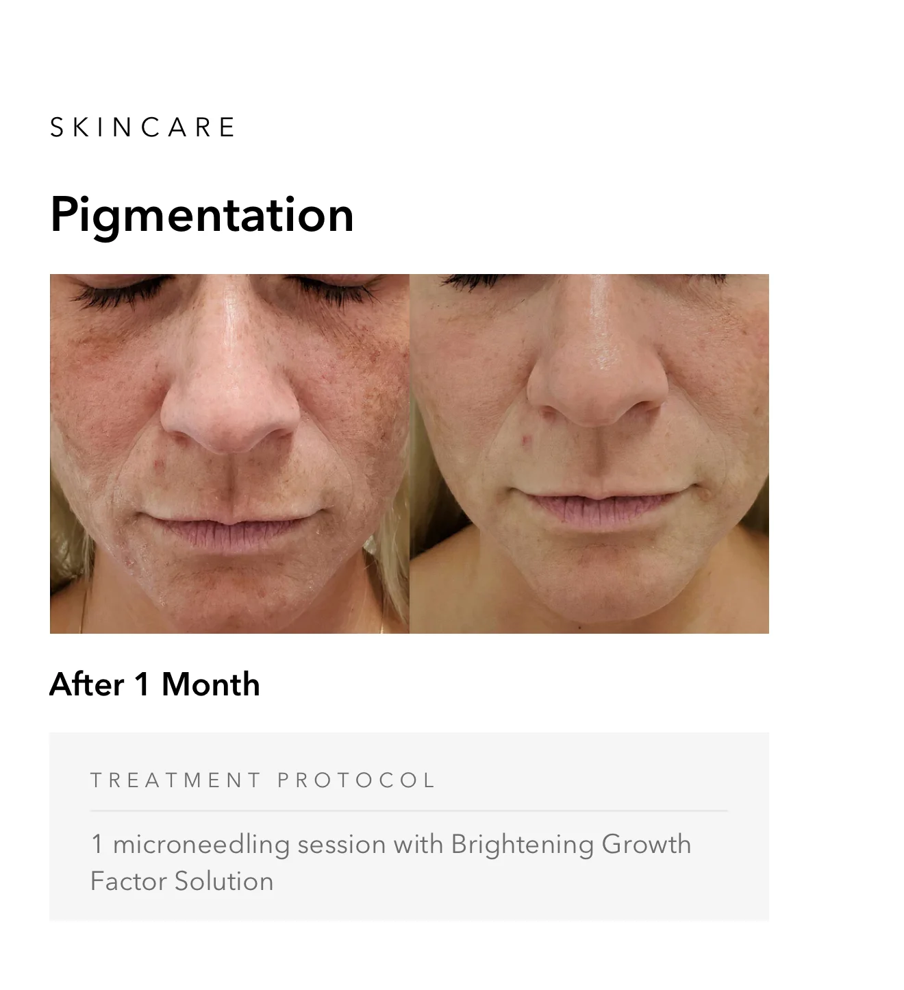 ejuvapen-microneedling-nxt-gallery-f