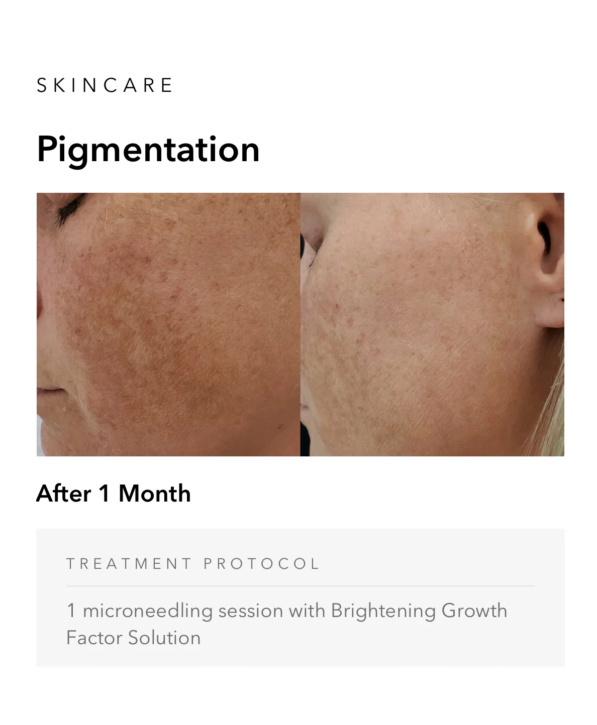 ejuvapen-microneedling-nxt-gallery-g