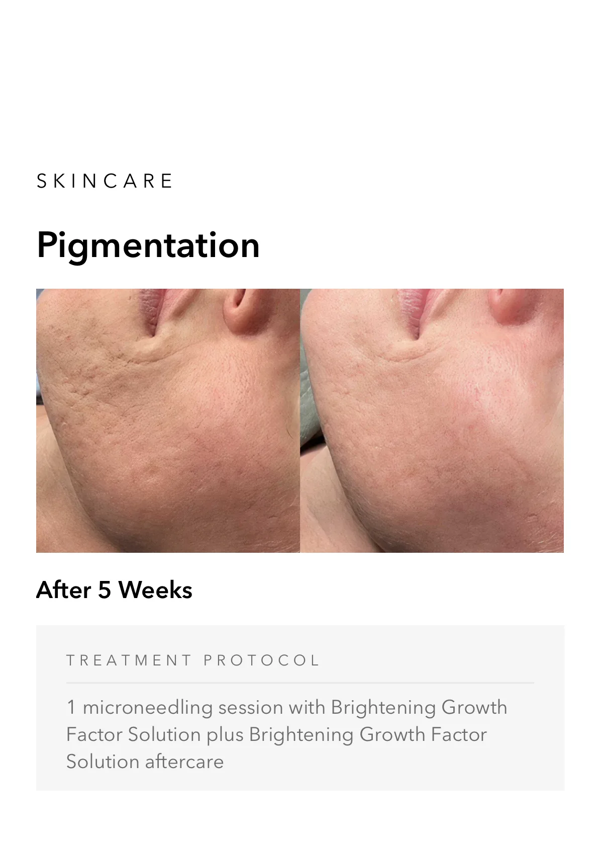 ejuvapen-microneedling-nxt-gallery-h