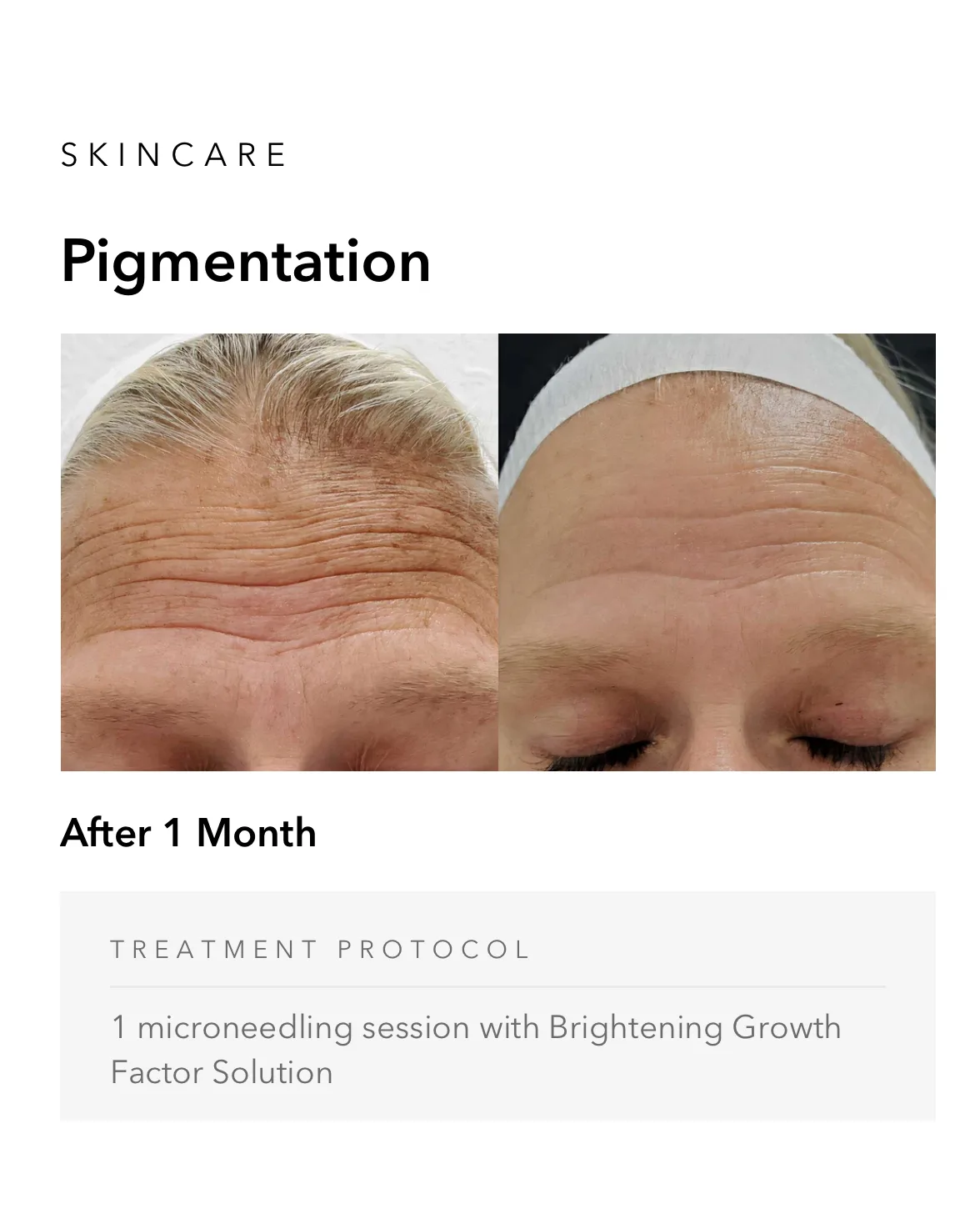 ejuvapen-microneedling-nxt-gallery-i