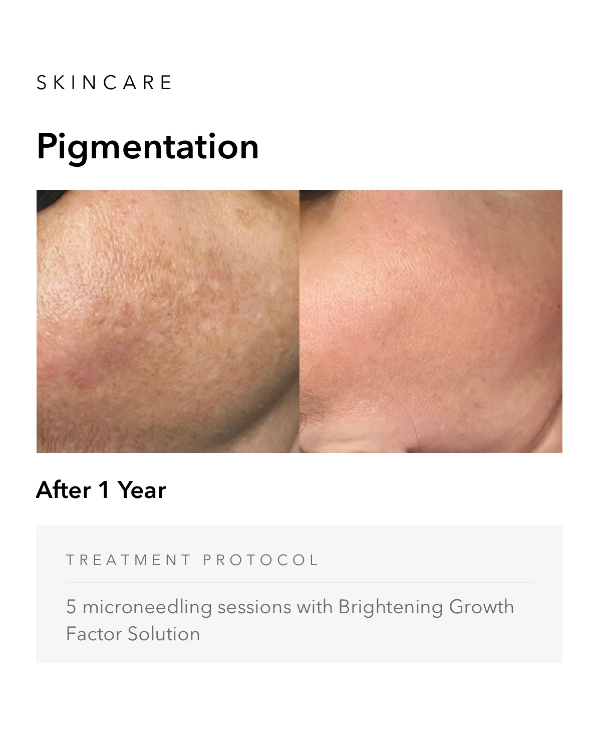 ejuvapen-microneedling-nxt-gallery-j