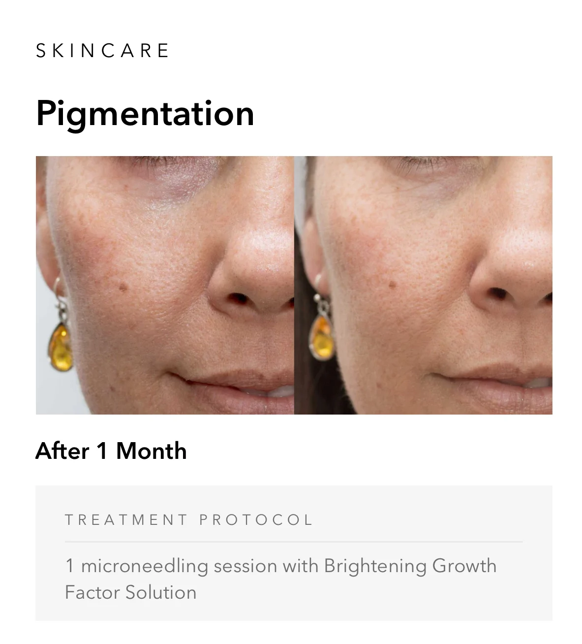 ejuvapen-microneedling-nxt-gallery-k