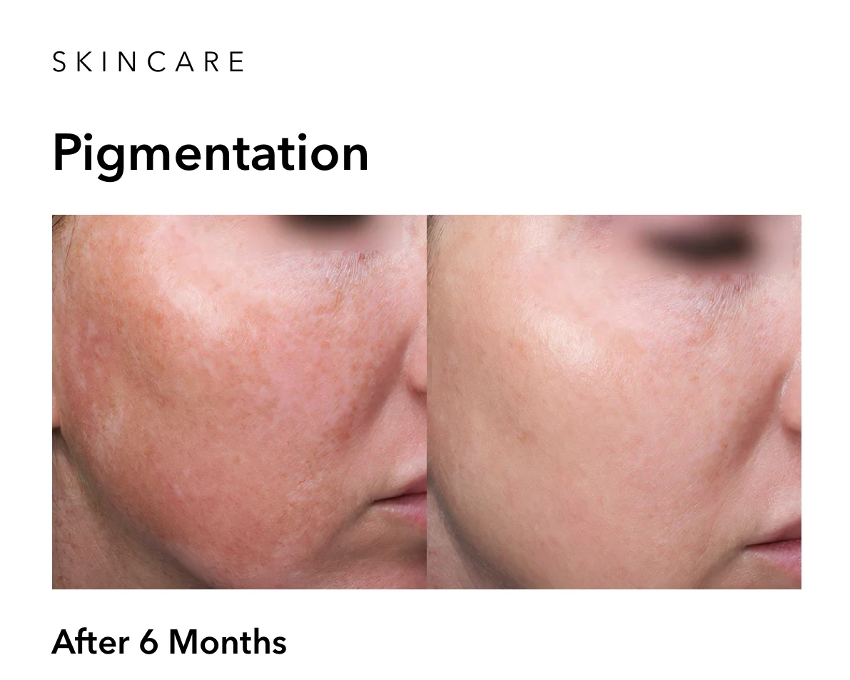 Chemical peel before and after skin transformation