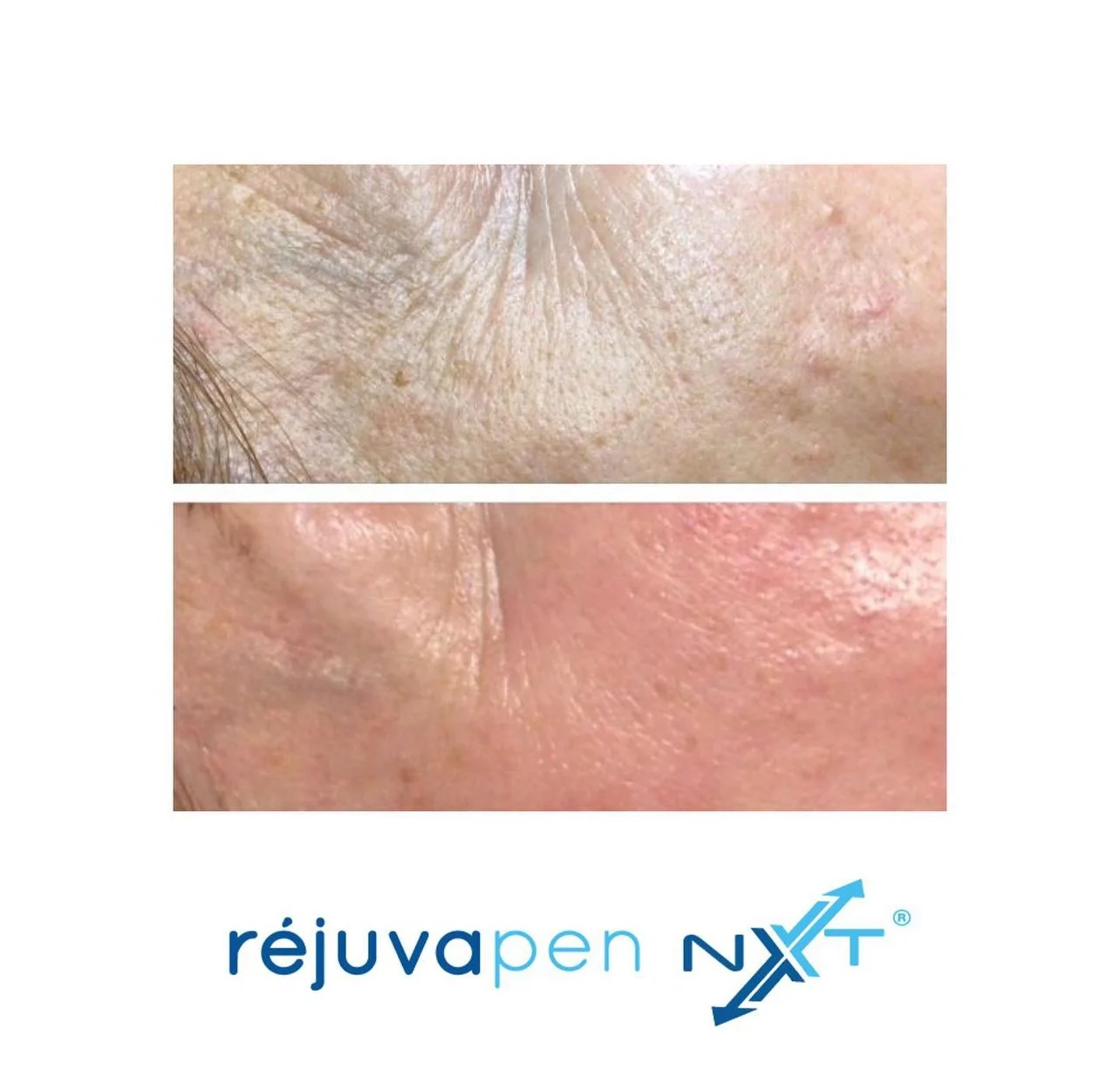 Skin pigmentation treatment before and after results