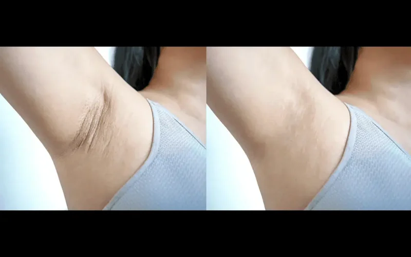 Intimate Lightning Body Peel a in Marietta GA