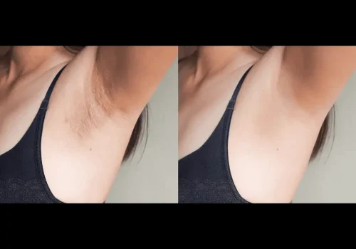 Intimate Lightning Body Peel in Marietta GA | APMU Med Spa