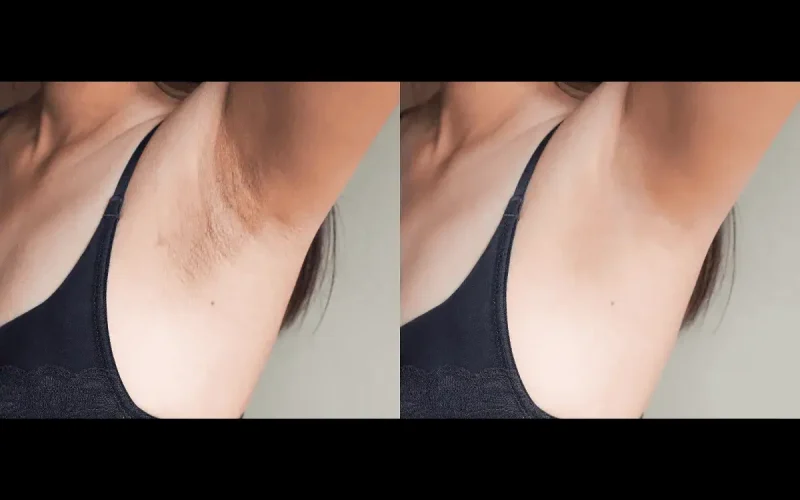 Intimate Lightning Body Peel in Marietta GA | APMU Med Spa